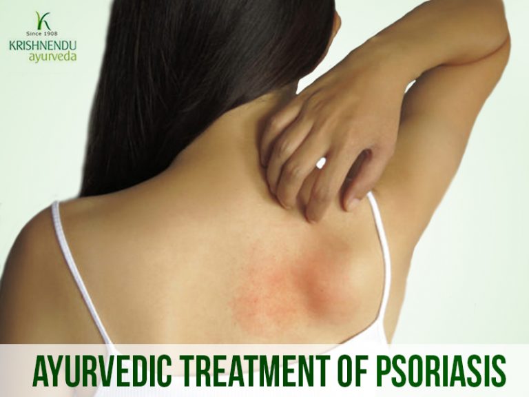 Read more about the article Ayurvedic Treatment Of Psoriasis