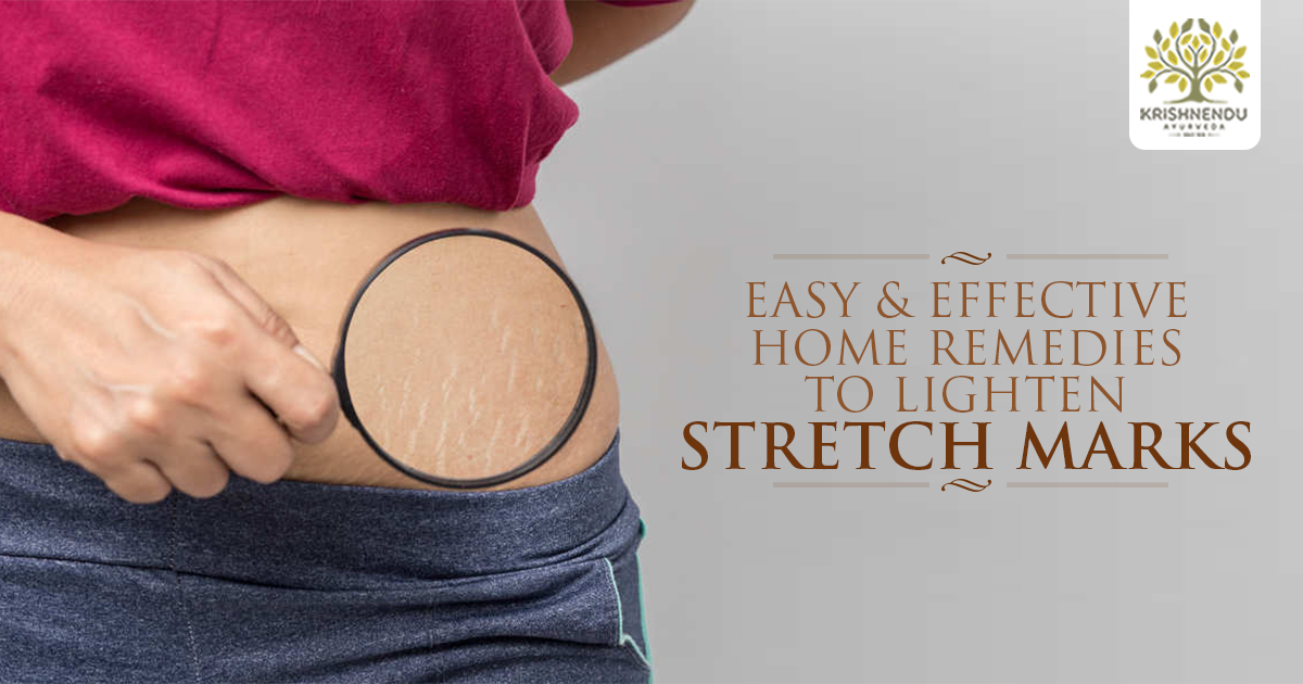 You are currently viewing 8 Easy & Effective Home Remedies to Lighten Stretch Marks