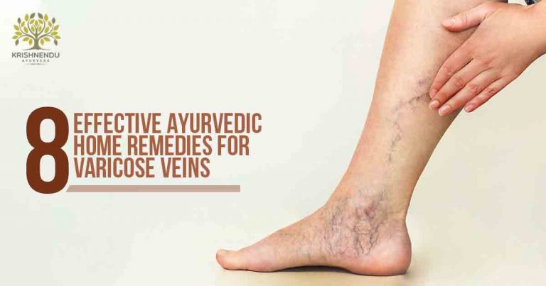 Read more about the article VARICOSE VEINS: 8 EFFECTIVE AYURVEDIC HOME REMEDIES
