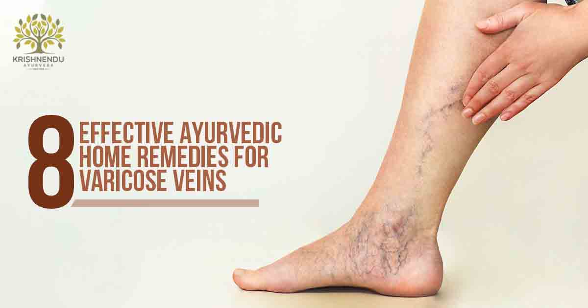 You are currently viewing VARICOSE VEINS: 8 EFFECTIVE AYURVEDIC HOME REMEDIES